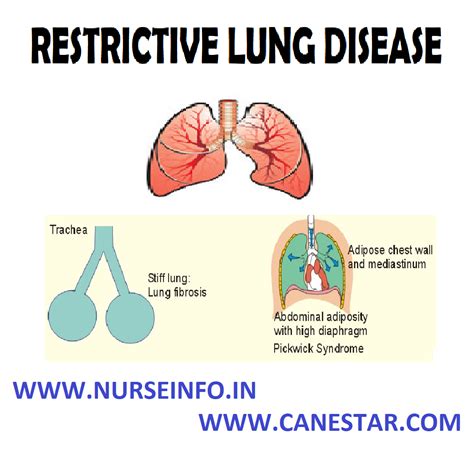 weight obesity restrictive lung disease